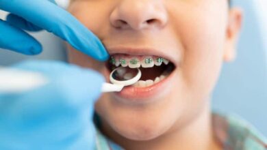 Dental Braces