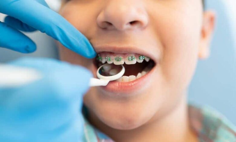 Dental Braces