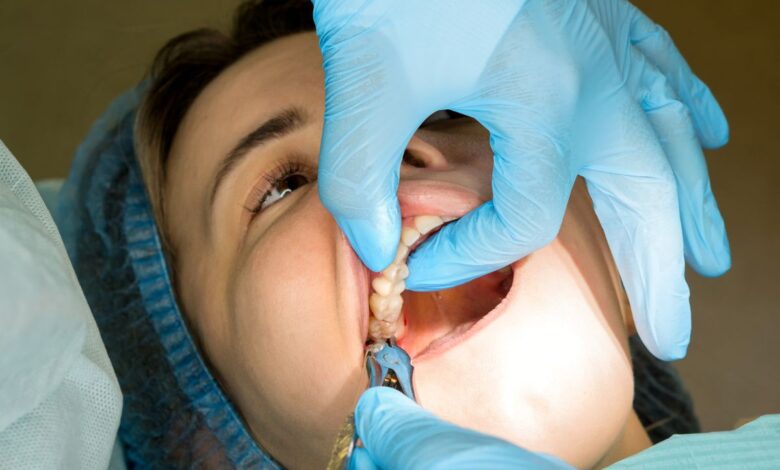Wisdom Tooth Extraction